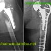 Phục hồi chức năng gãy thân xương đùi