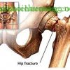 Phục hồi chức năng vỡ xương chậu