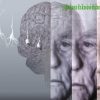 Phục hồi chức năng bệnh Alzheimer