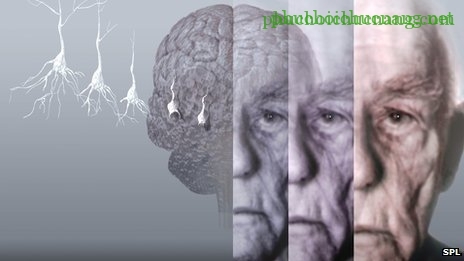 alzheimer_s_disease 2