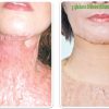 Phục hồi chức năng cho người bệnh vá da