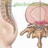 Điều trị thoát vị đĩa đệm bằng phương pháp châm cứu