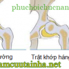 Phục hồi chức năng trật khớp háng