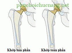 Gãy cổ xương đùi và hướng điều trị