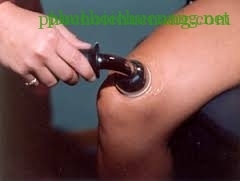 Image result for ultrasound treatment