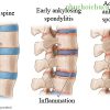 Bệnh học: Viêm cột sống dính khớp
