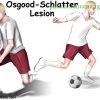 Bệnh Osgood-Schlatter(viêm lồi củ xương chày trẻ em) Nguyên nhân và cách trị