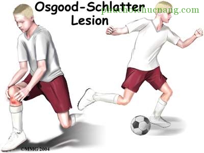 Bệnh Osgood-Schlatter(viêm khớp gối trẻ em) Nguyên nhân và cách trị 1