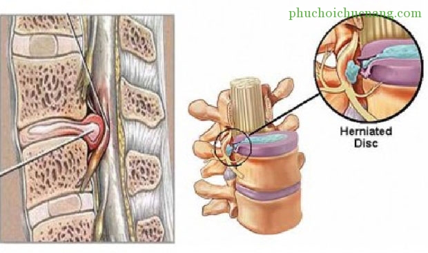 Cận lâm sàng: Hình ảnh chèn ép tủy - Phục hồi chức năng