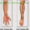 Chẩn đoán và xử trí gãy xương hở