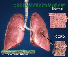 copd-2