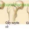 Gãy cổ xương đùi và hướng điều trị