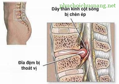 Chữa đau thần kinh tọa thế nào?