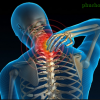 Phục hồi chức năng thoái hóa Cột sống cổ