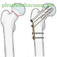 Gãy cổ xương đùi và hướng điều trị