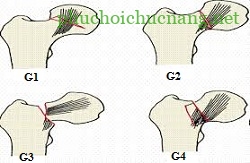 Gãy cổ xương đùi và hướng điều trị