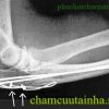 Phục hồi chức năng gãy mỏm khuỷu