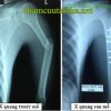 Phục hồi chức năng gãy thân xương cánh tay