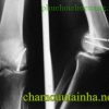 Phục hồi chức năng gãy trên lồi cầu xương cánh tay