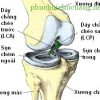 Phục hồi chức năng sau phẫu thuật tái tạo dây chằng chéo sau khớp gối