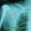 Phục hồi chức năng sau phẫu thuật thay khớp vai
