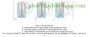 mất tương xứng chiều dài của chân