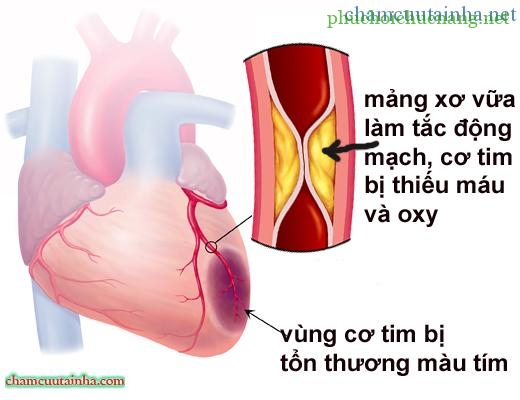 nhoi-mau-co_tim