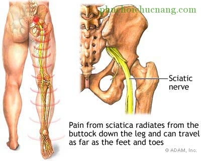 Vật lý trị liệu chữa đau thần kinh tọa