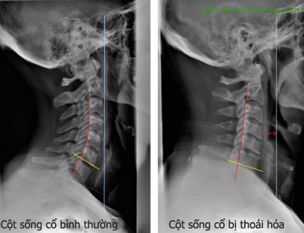 Thoái hóa cột sống cổ