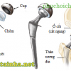 Phục hồi chức năng sau phẫu thuật thay khớp háng