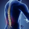 Phục hồi chức năng bệnh gai cột sống