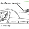 Phục hồi chức năng hội chứng ngón tay lò xo