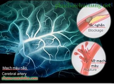 Hướng dẫn phục hồi chức năng bệnh nhân tai biến mạch máu não