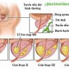 Video hướng dẫn tập Phục hồi chức năng Ung thư tiền liệt tuyến