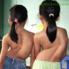 Phục hồi chức năng cho trẻ cong vẹo cột sống
