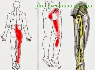 Bài tập vật lý trị liệu cho bệnh nhân đau thần kinh tọa