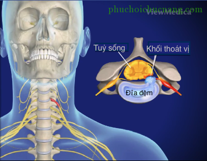 Thoát vị đĩa đệm cột sống cổ