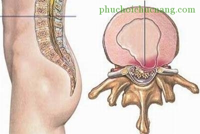 Phục hồi chức năng thoát vị đĩa đệm cột sống thắt lưng