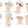 Phục hồi chức năng sau phẫu thuật gãy đầu trên xương cánh tay