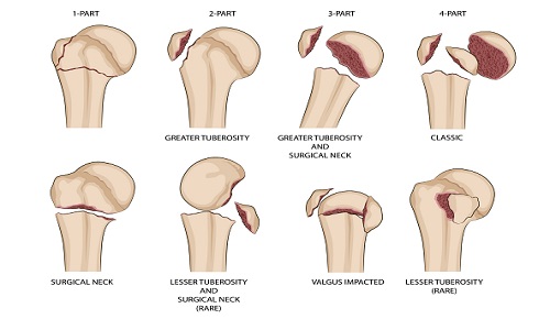 Phục hồi chức năng sau phẫu thuật gãy đầu trên xương cánh tay