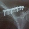 Phục hồi chức năng sau phẫu thuật kết hợp xương gãy xương đòn