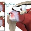 Phục hồi chức năng sau phẫu thuật mổ nội soi gân cơ chóp xoay